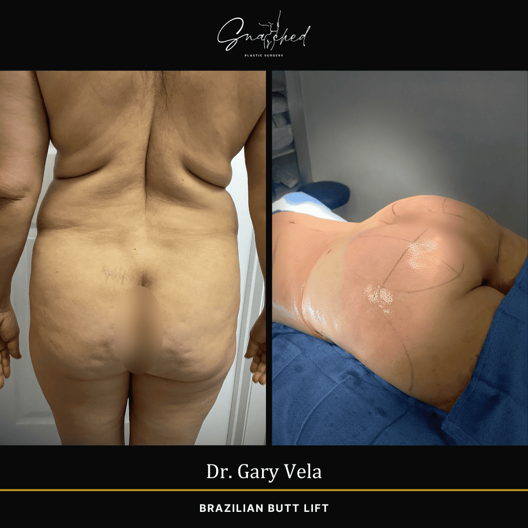 Brazilian Butt Lift by Dr. Gary Vela