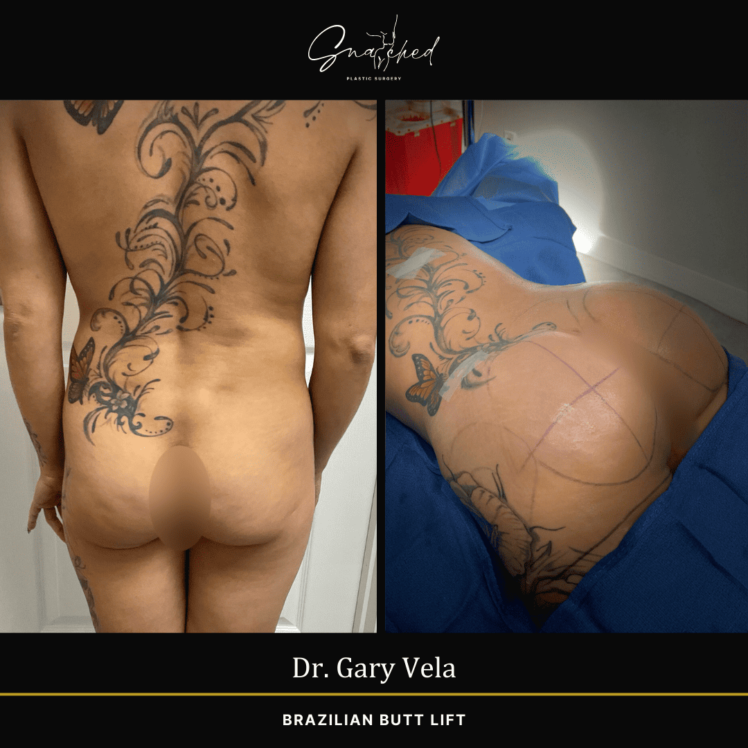 Brazilian Butt Lift by Dr. Gary Vela