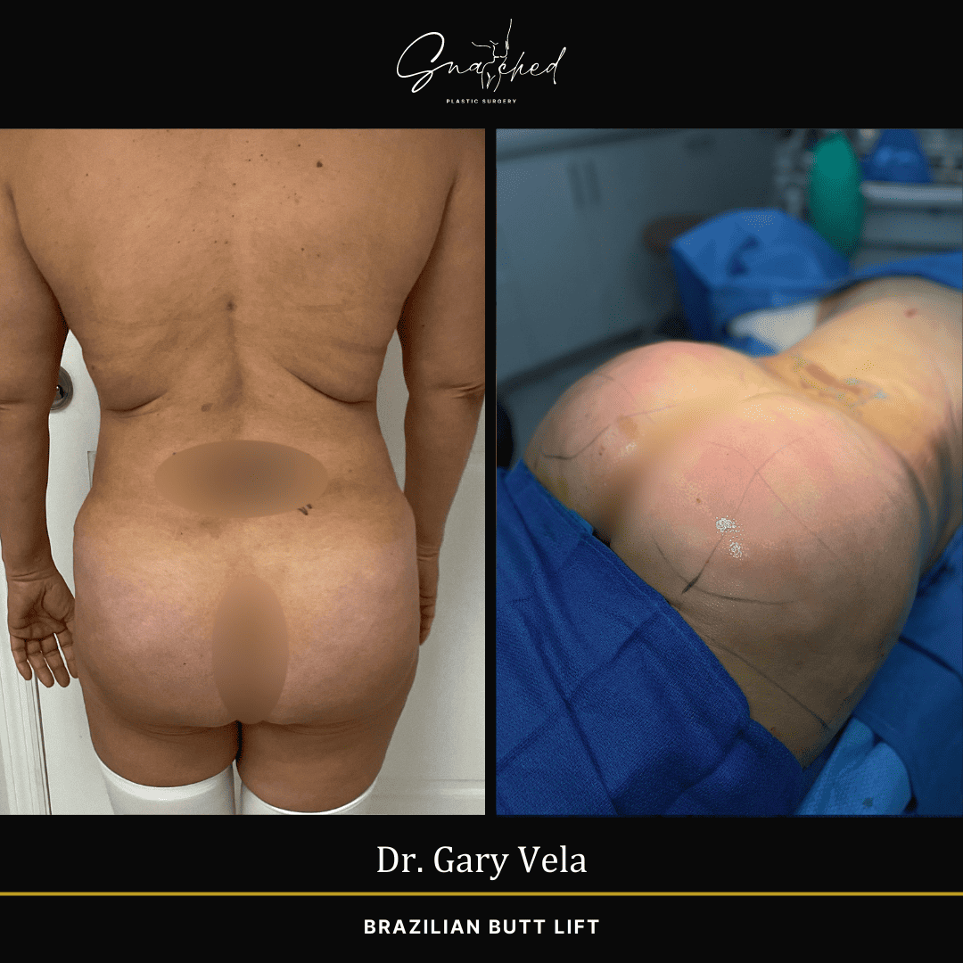 Brazilian Butt Lift by Dr. Gary Vela