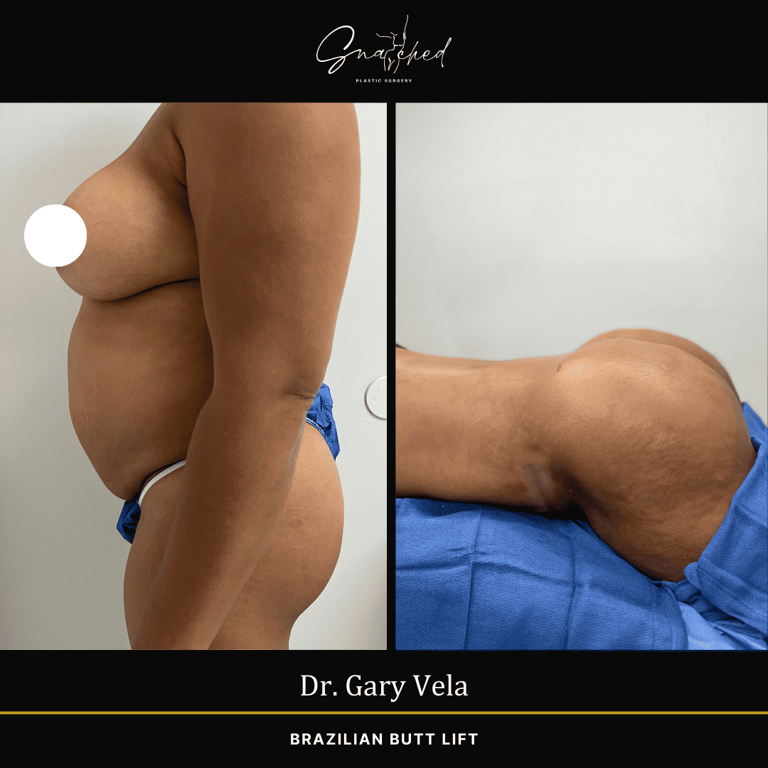 Brazilian Butt Lift by Dr. Gary Vela