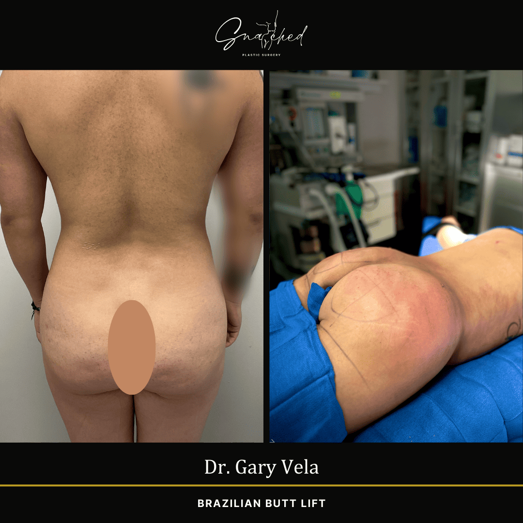 Brazilian Butt Lift by Dr. Gary Vela