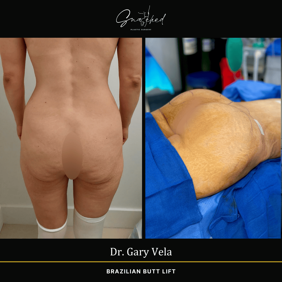Brazilian Butt Lift by Dr. Gary Vela