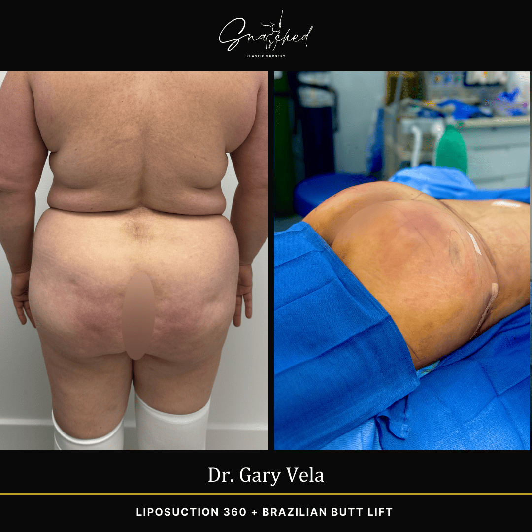Brazilian Butt Lift by Dr. Gary Vela