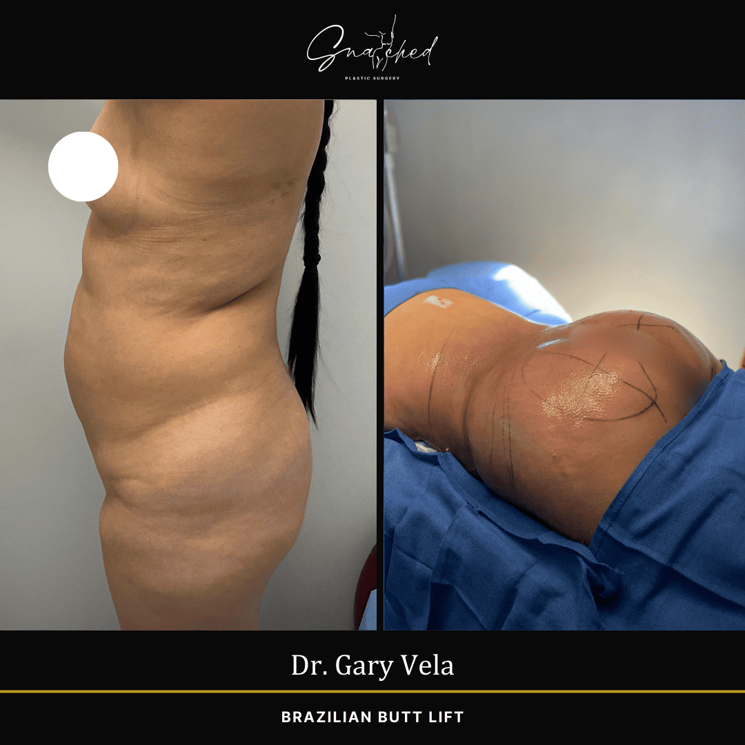 Brazilian Butt Lift by Dr. Gary Vela