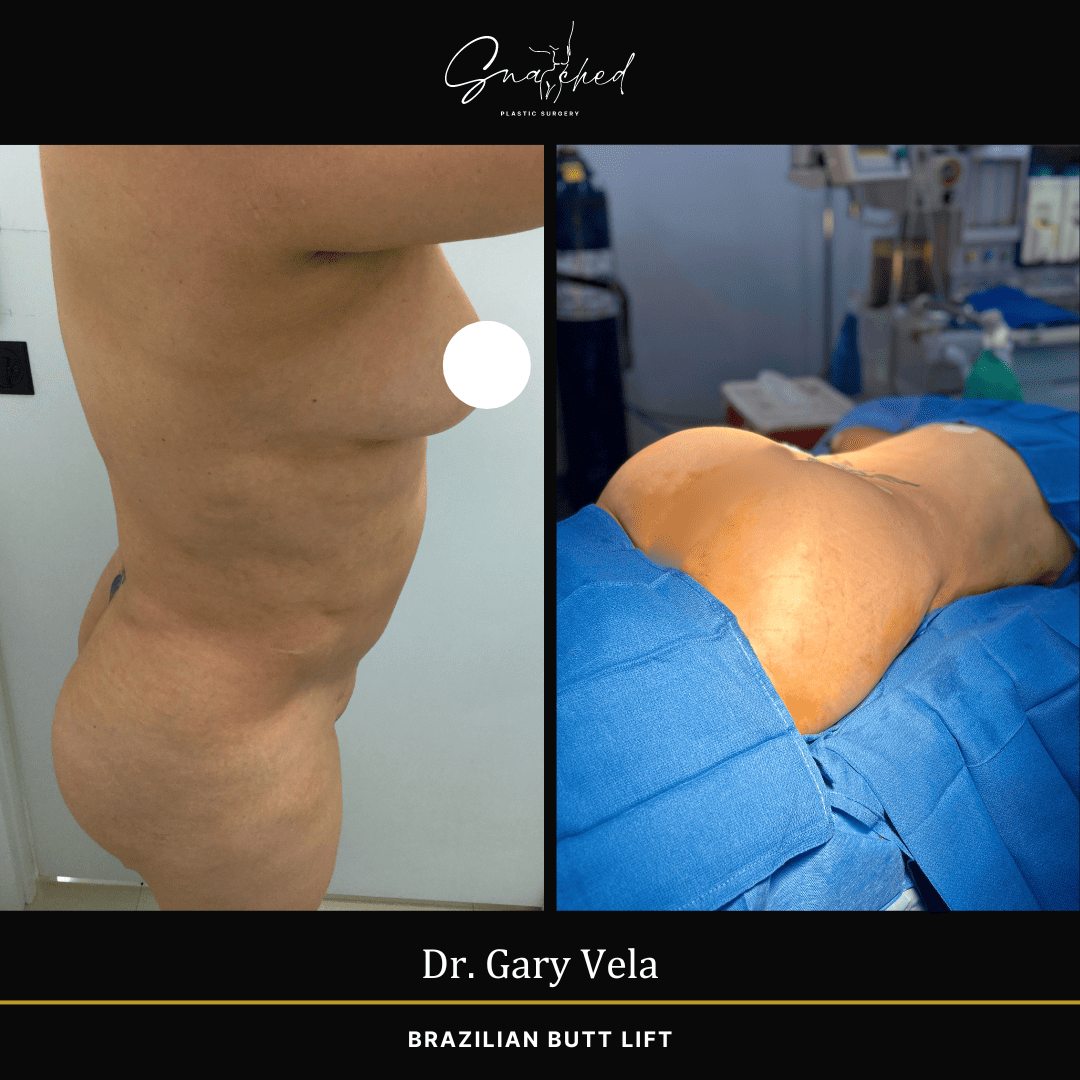 Brazilian Butt Lift by Dr. Gary Vela
