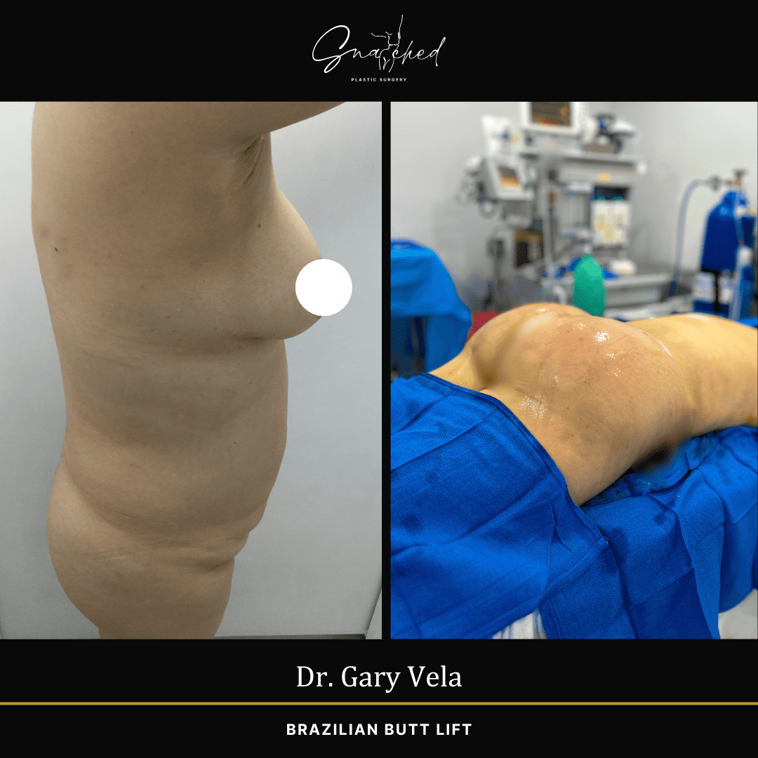 Brazilian Butt Lift by Dr. Gary Vela