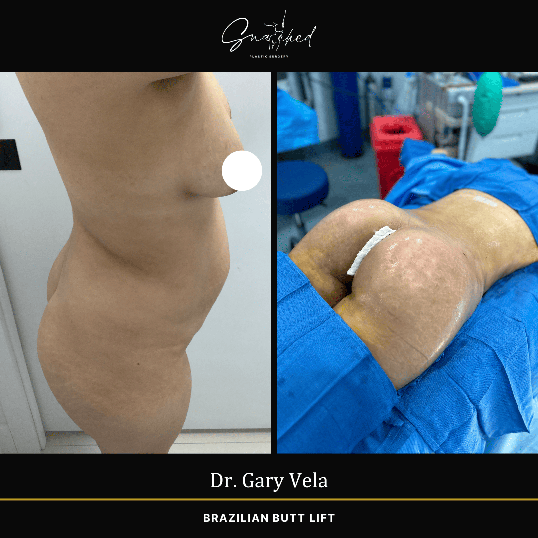 Brazilian Butt Lift by Dr. Gary Vela