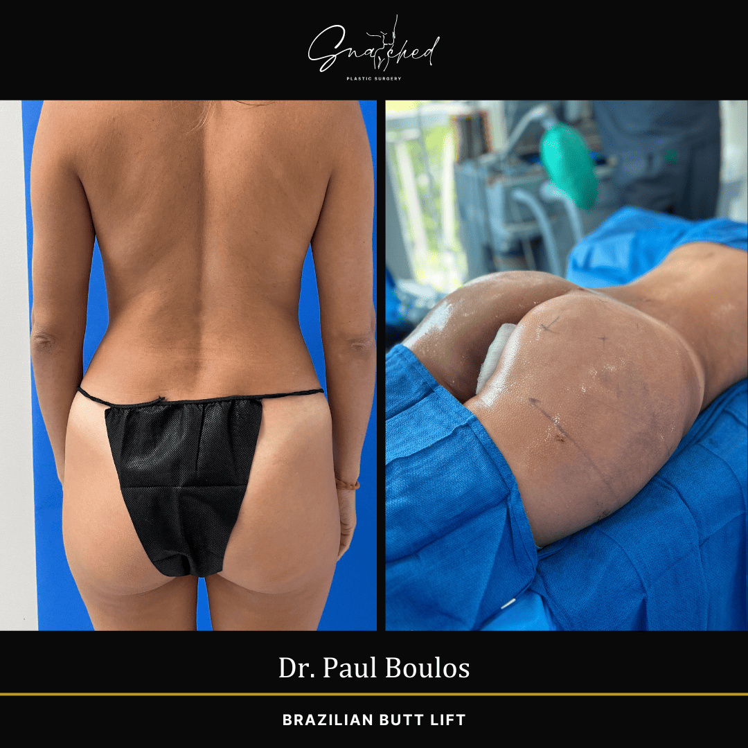Brazilian Butt Lift by Dr. Boulos