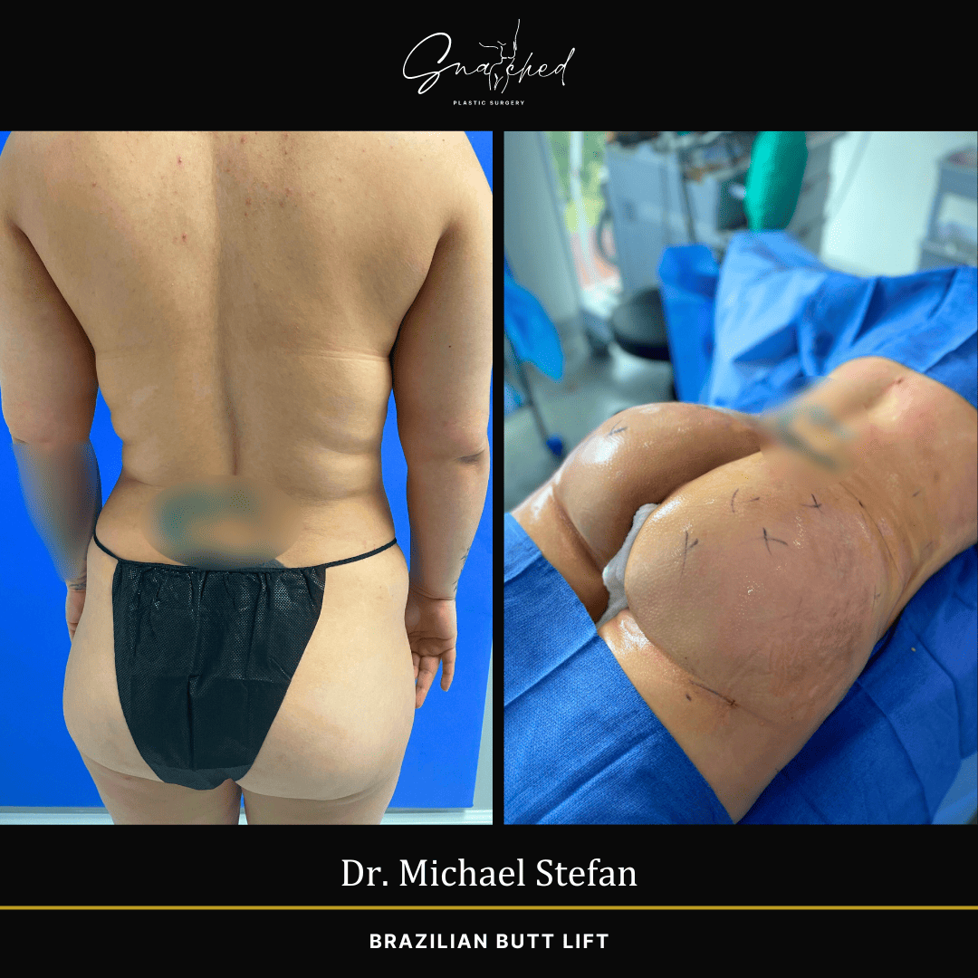Brazilian Butt Lift by Dr. Stefan
