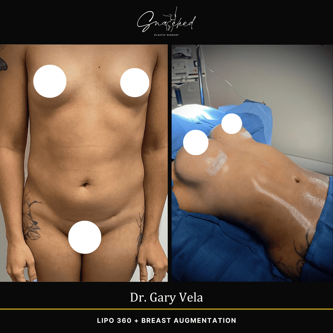 Lipo 360 by Dr. Vela