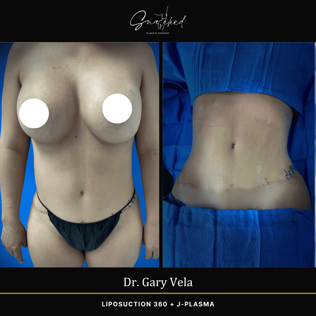 Lipo 360 by Dr. Vela