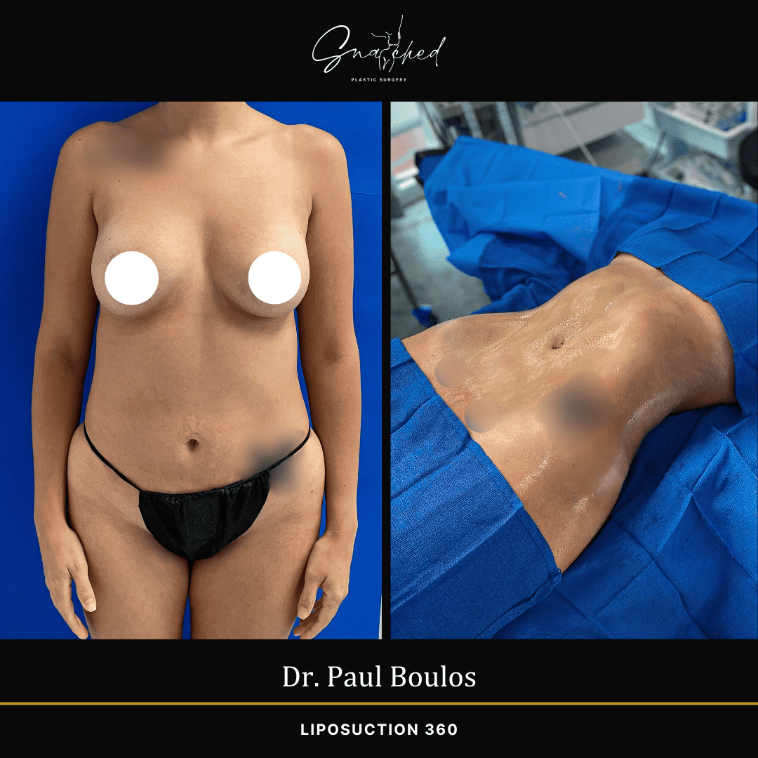 Lipo 360 by Dr. Boulos