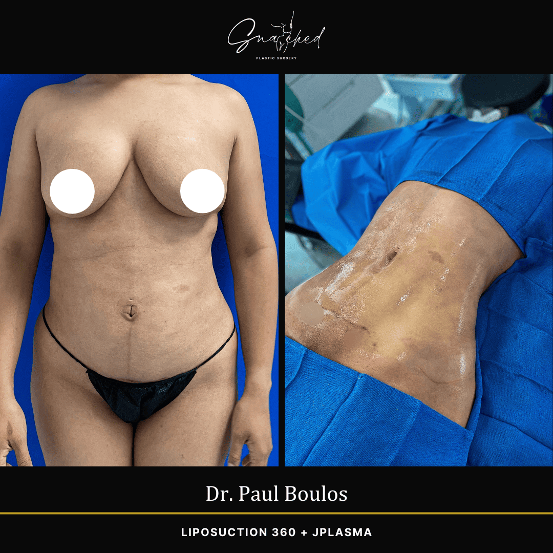 Lipo 360 by Dr. Boulos