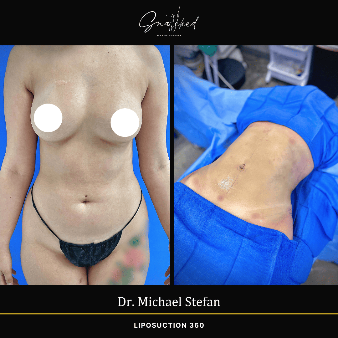 Lipo 360 by Dr. Stefan