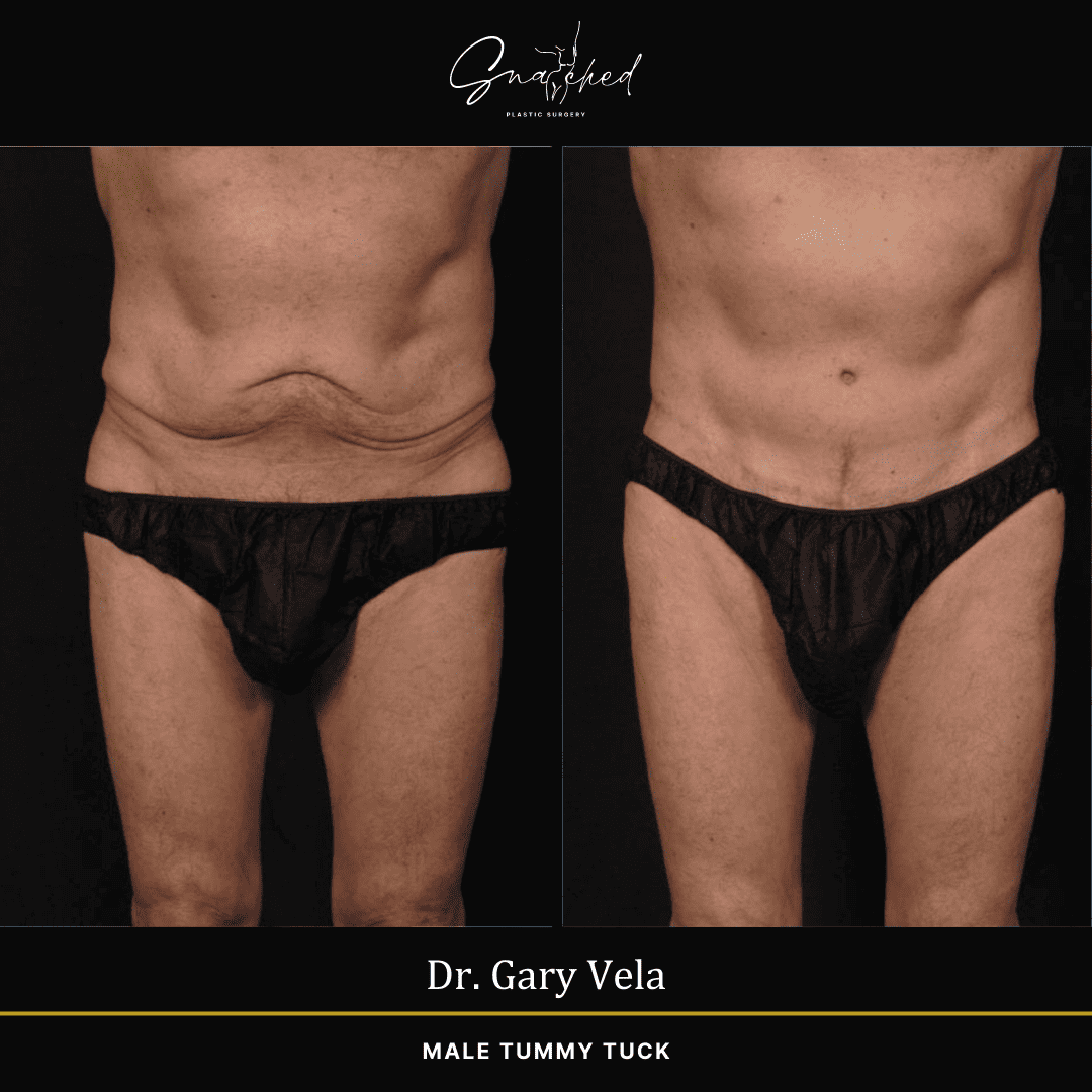 maletummytuck-01-vela
