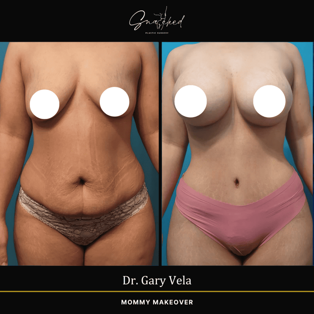 Mommy Makeover by Dr. Vela