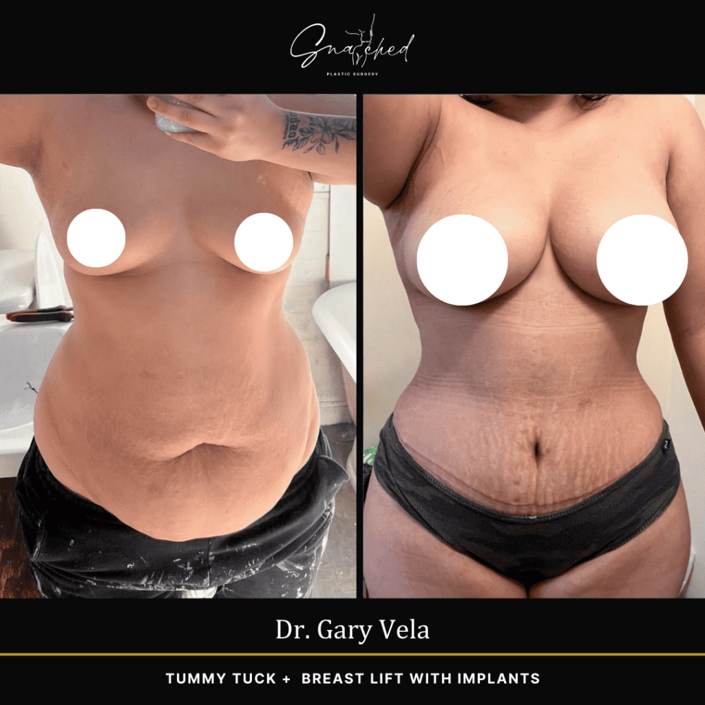 Mommy Makeover by Dr. Vela