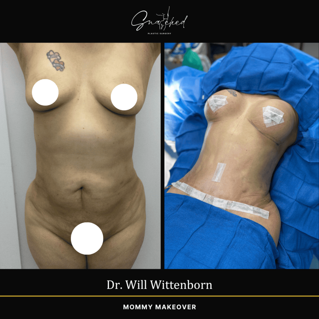 Mommy Makeover by Dr. Wittenborn
