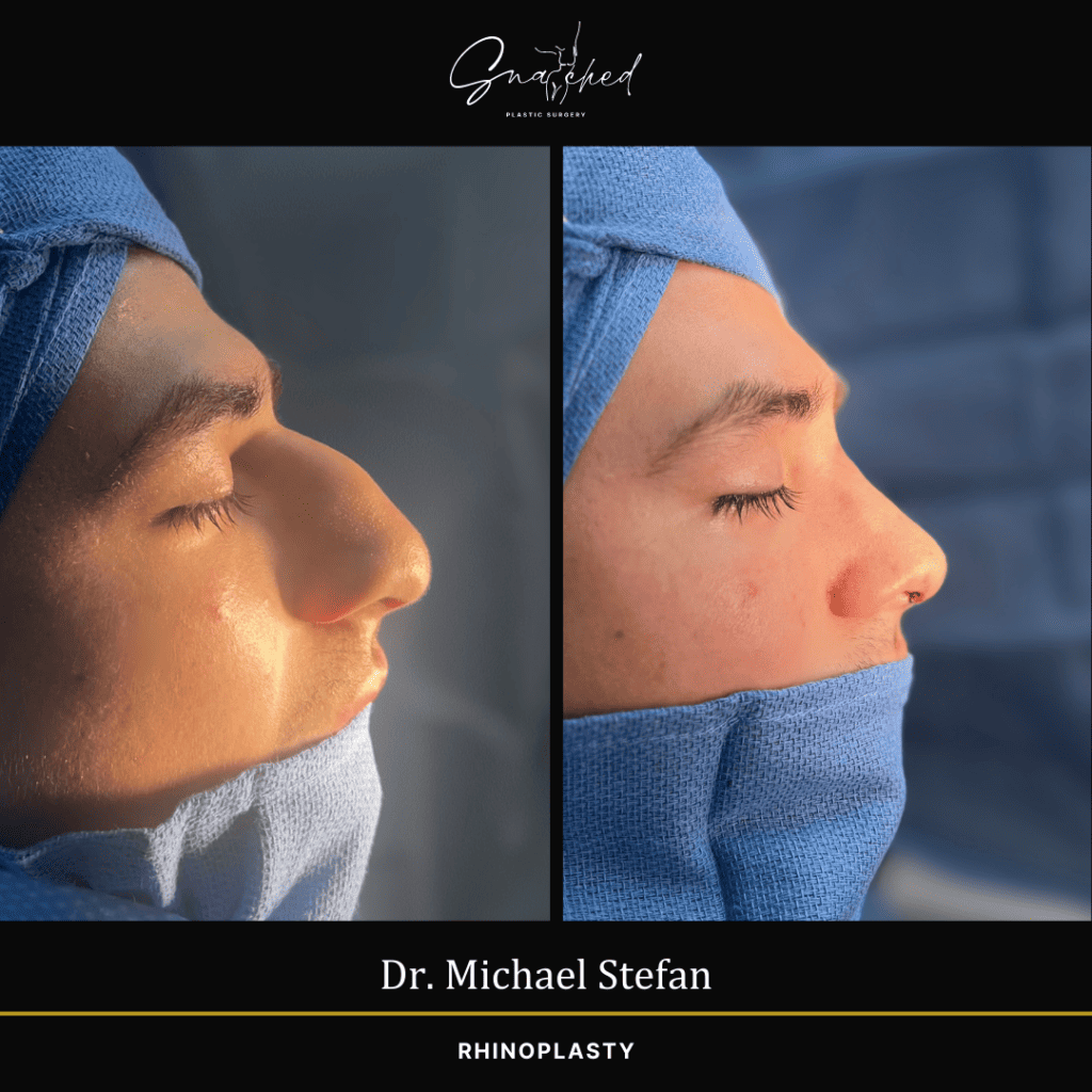 Rhinoplasty by Dr. Stefan