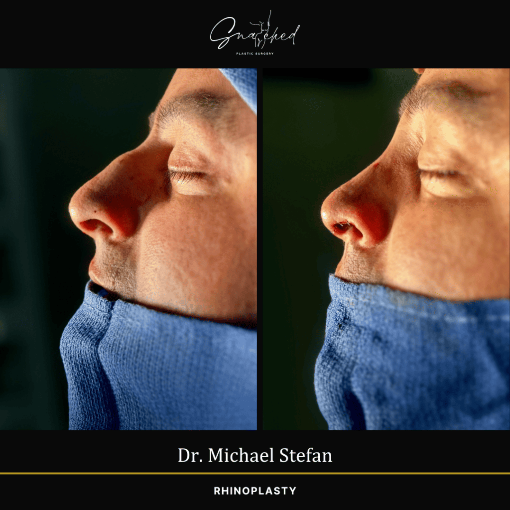 Rhinoplasty by Dr. Stefan