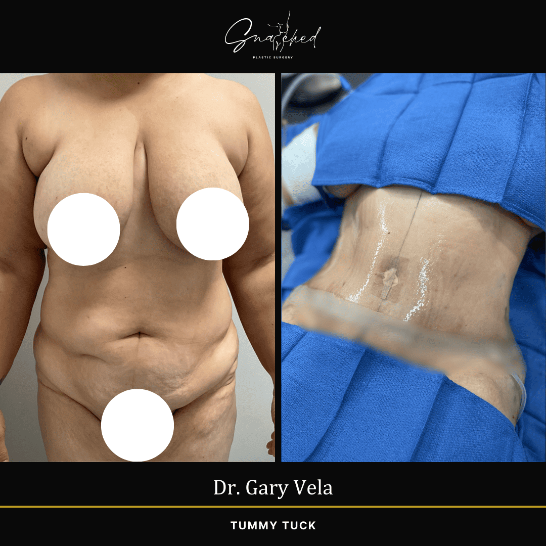 tummytuck-01-vela