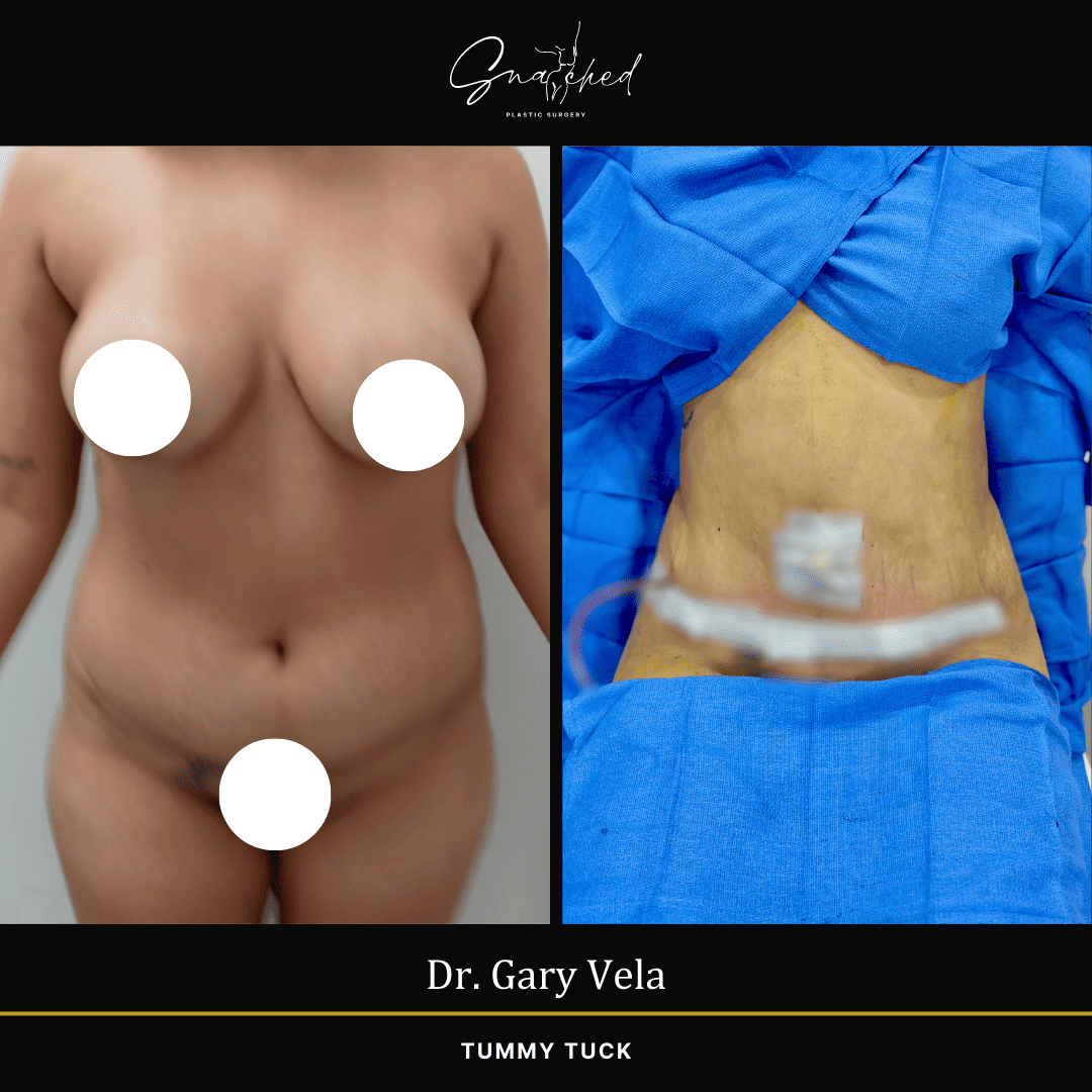tummytuck-02-vela