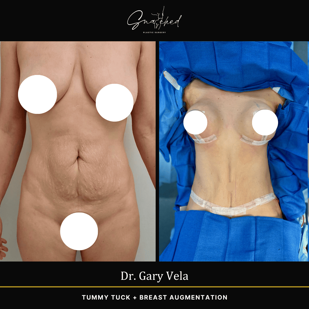 tummytuck-03-vela