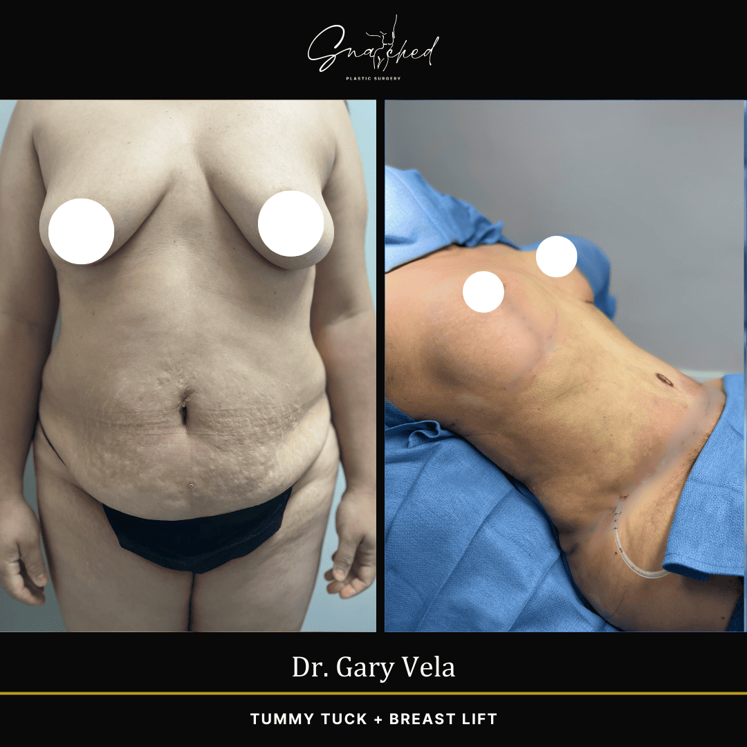 tummytuck-04-vela