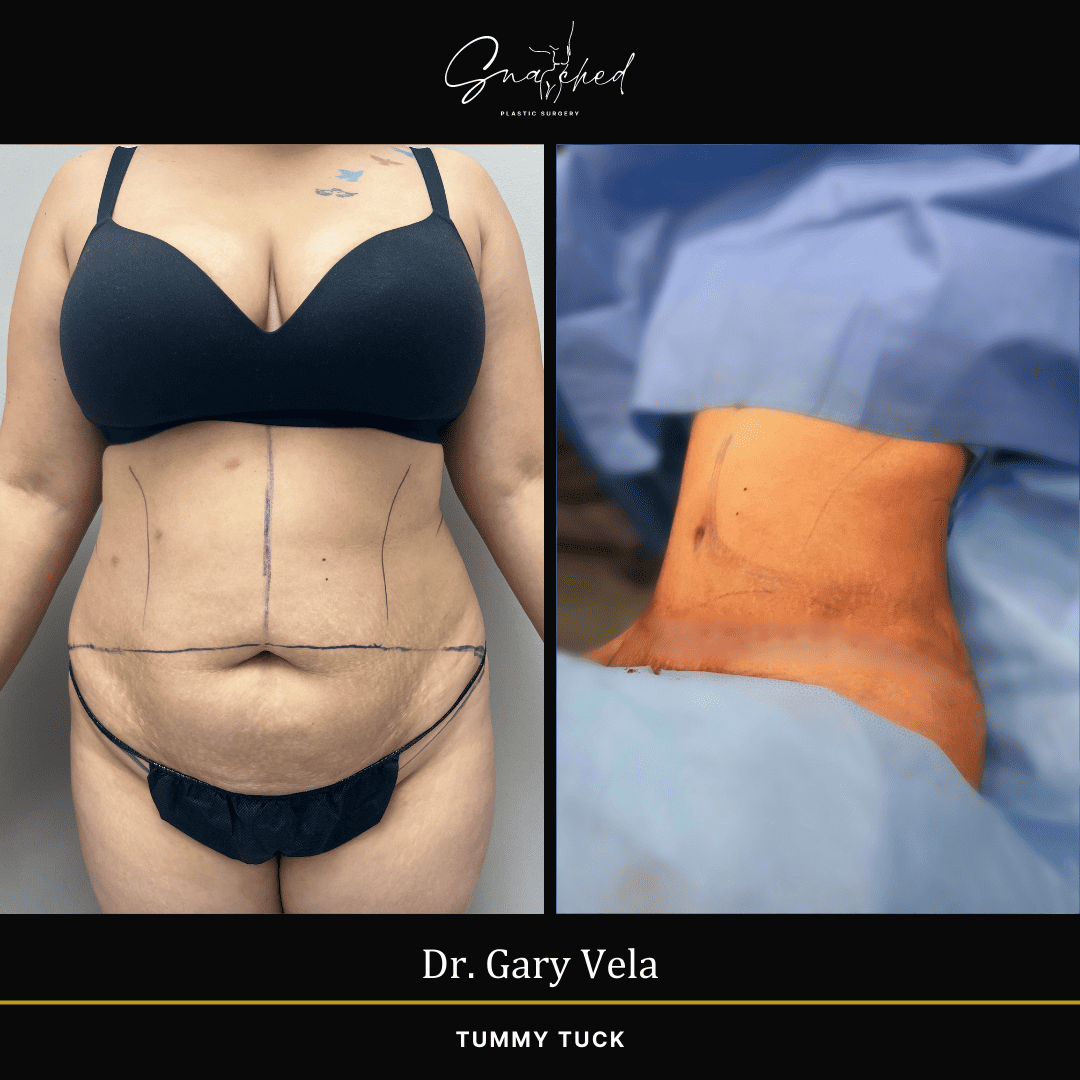 tummytuck-05-vela