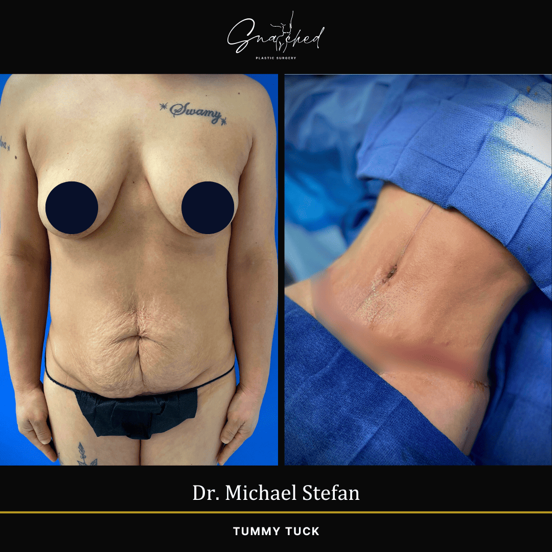 tummytuck-06-stefan