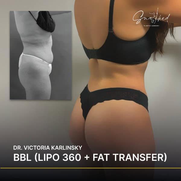 BBL surgery results, before and after images