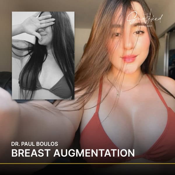 Woman post-breast augmentation in bikini, hands covering face.