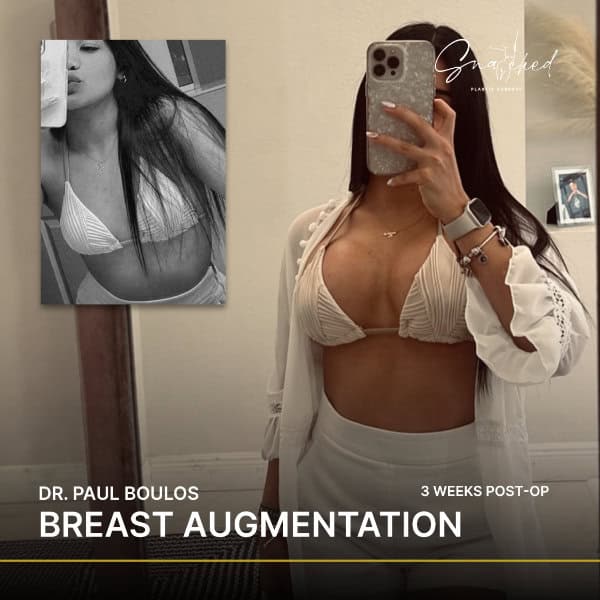Woman post-breast augmentation progress photos