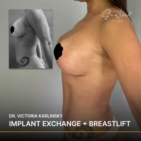 Breast implant exchange and lift side view photo