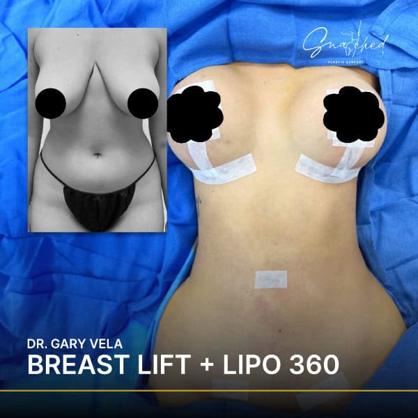 Breast lift and Lipo 360 procedure results
