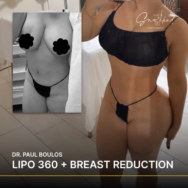 Body contouring and breast reduction results