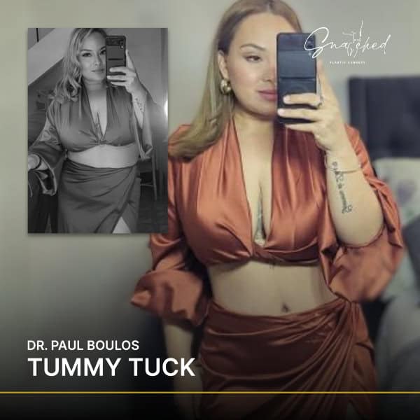 Woman showcasing tummy tuck results in mirror selfie.
