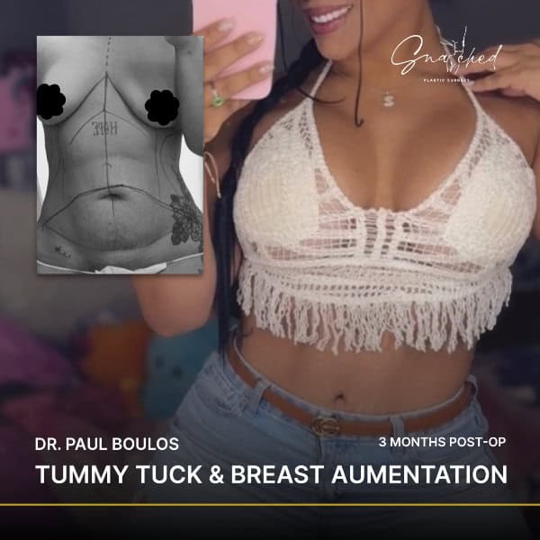 Tummy tuck and breast augmentation before and after.