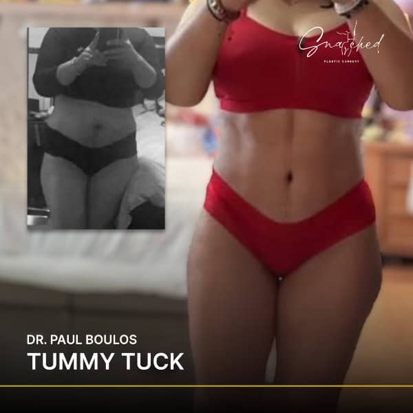 Tummy tuck before and after results comparison.