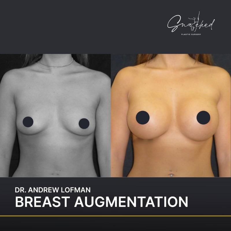 Before and after breast augmentation comparison.