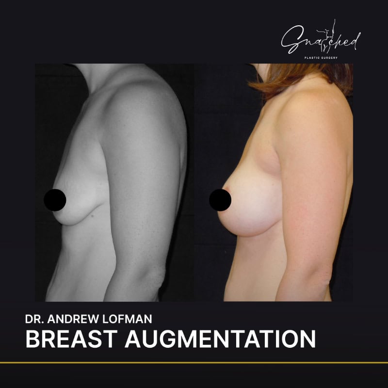 Breast augmentation before and after comparison.