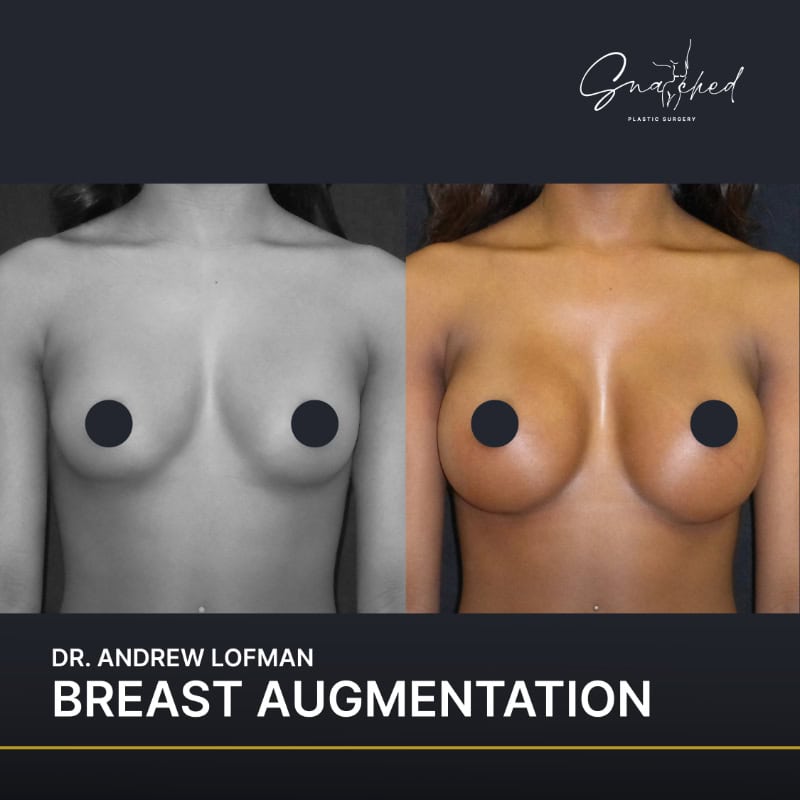 Breast augmentation before and after comparison
