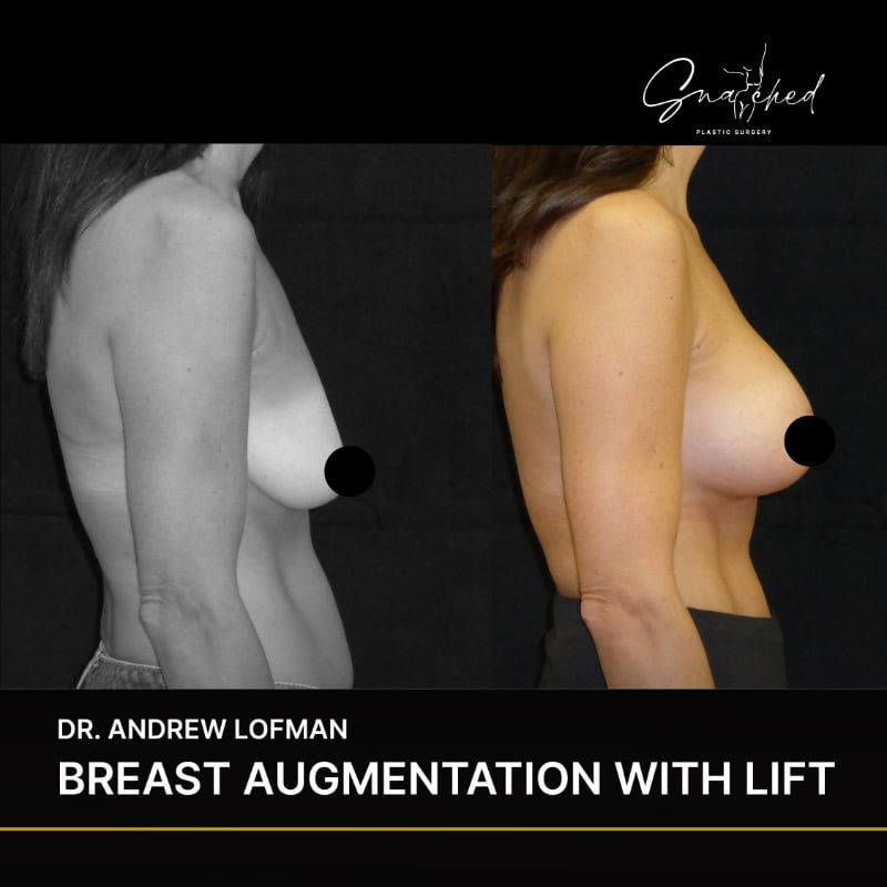 Before and after breast augmentation with lift results.