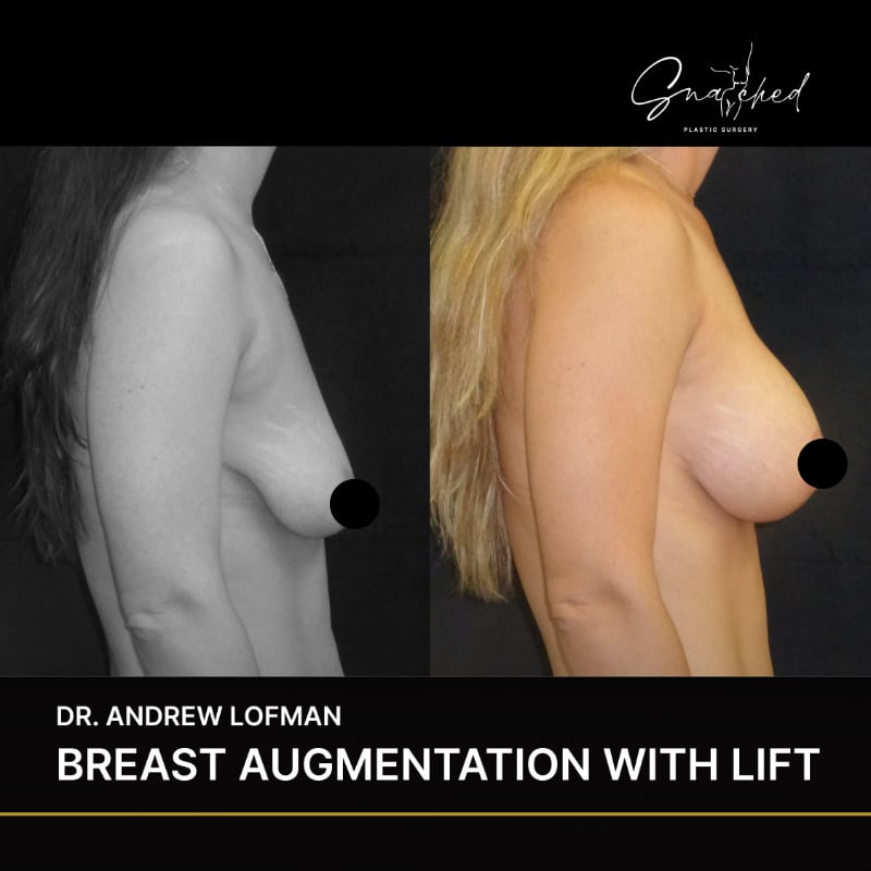 Before and after breast augmentation with lift results.