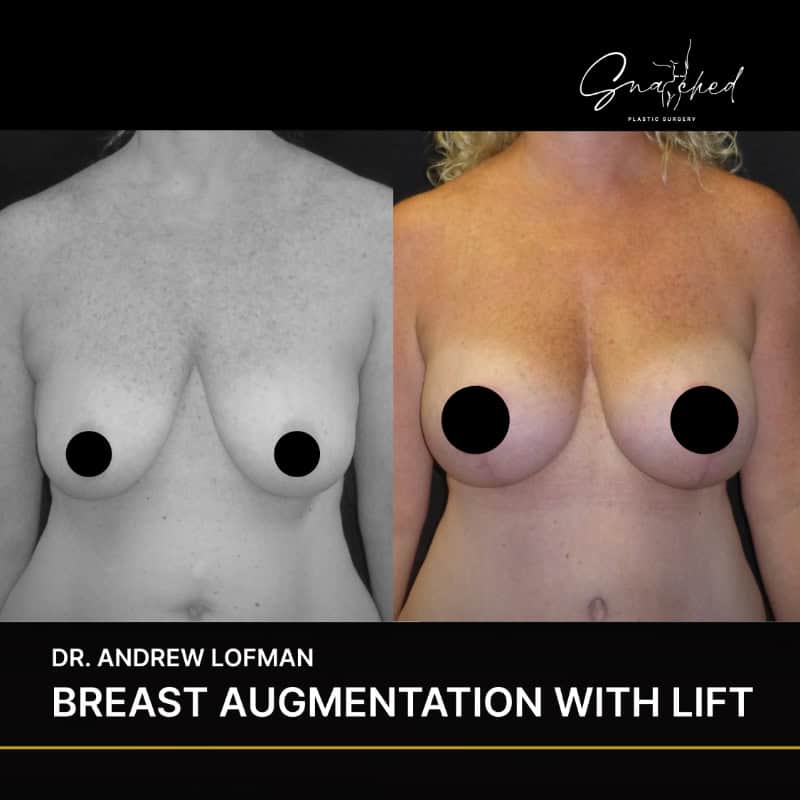Before and after breast augmentation with lift.