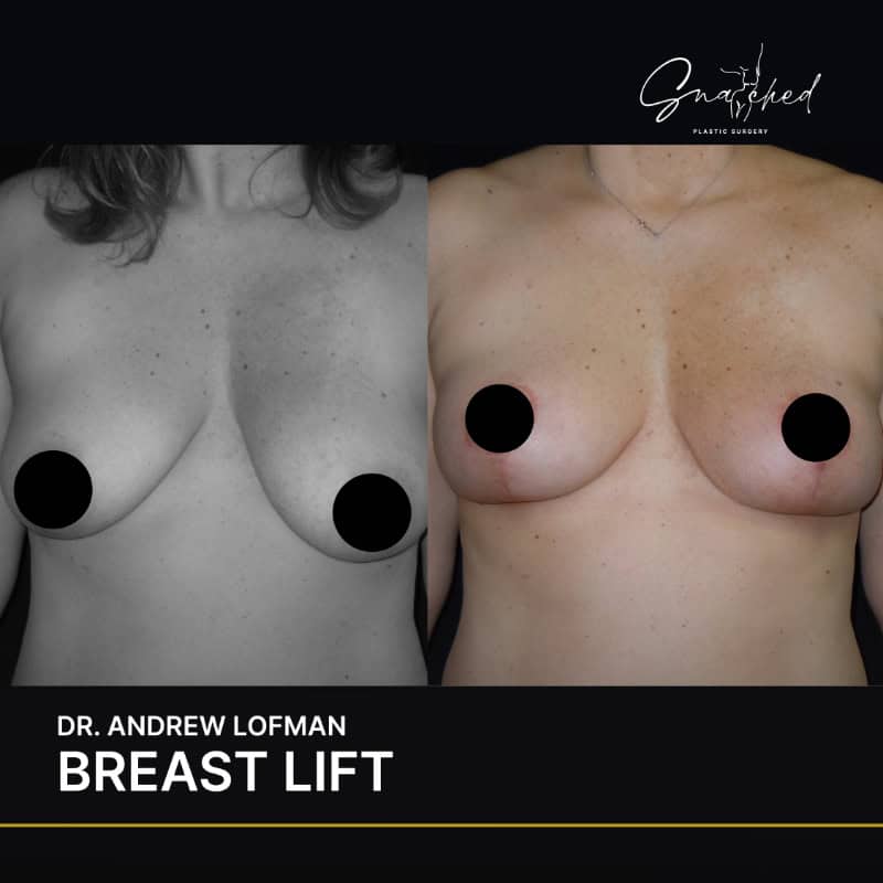 Before and after breast lift comparison.