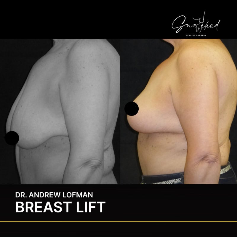 Before and after breast lift surgery comparison
