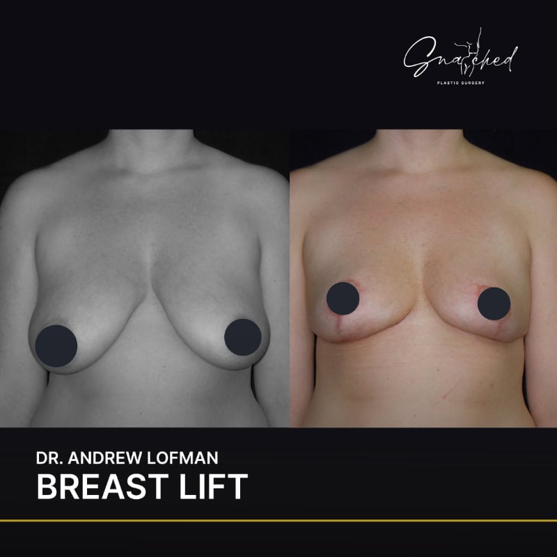 breastlift-03-lofman