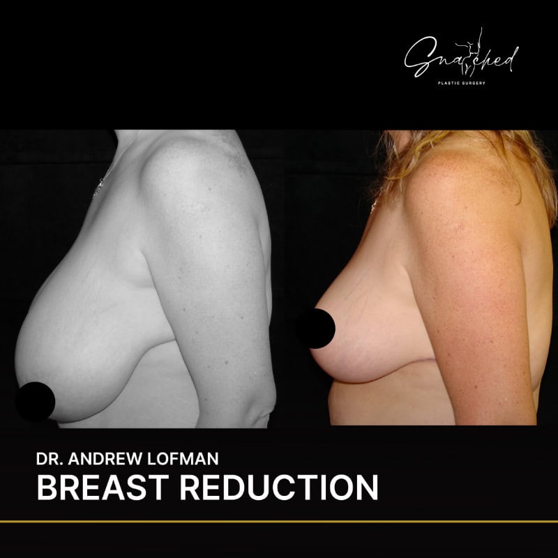Breast reduction before and after comparison