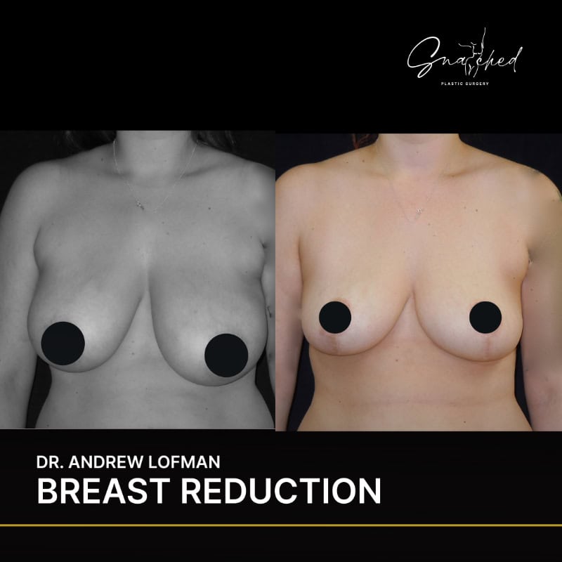 Before and after breast reduction comparison.